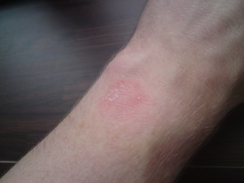 Rash On Wrist