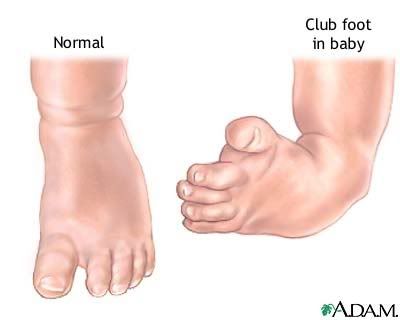 clubfoot.jpg club foot image by hartz18